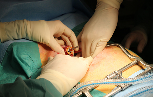 Implantatet er fremstillet af polycaprolactone, som allerede er godkendt til implantatbrug. Det passer til alle de specielle clipsemaskiner, der findes på markedet for operationsudstyr. Foto: Marianne Lie Becker. Implantatet er fremstillet af polycaprolactone, som allerede er godkendt til implantatbrug. Det passer til alle de specielle clipsemaskiner, der findes på markedet for operationsudstyr. Foto: Marianne Lie Becker.